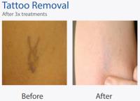 Laser Tattoo Removal Leicester image 10